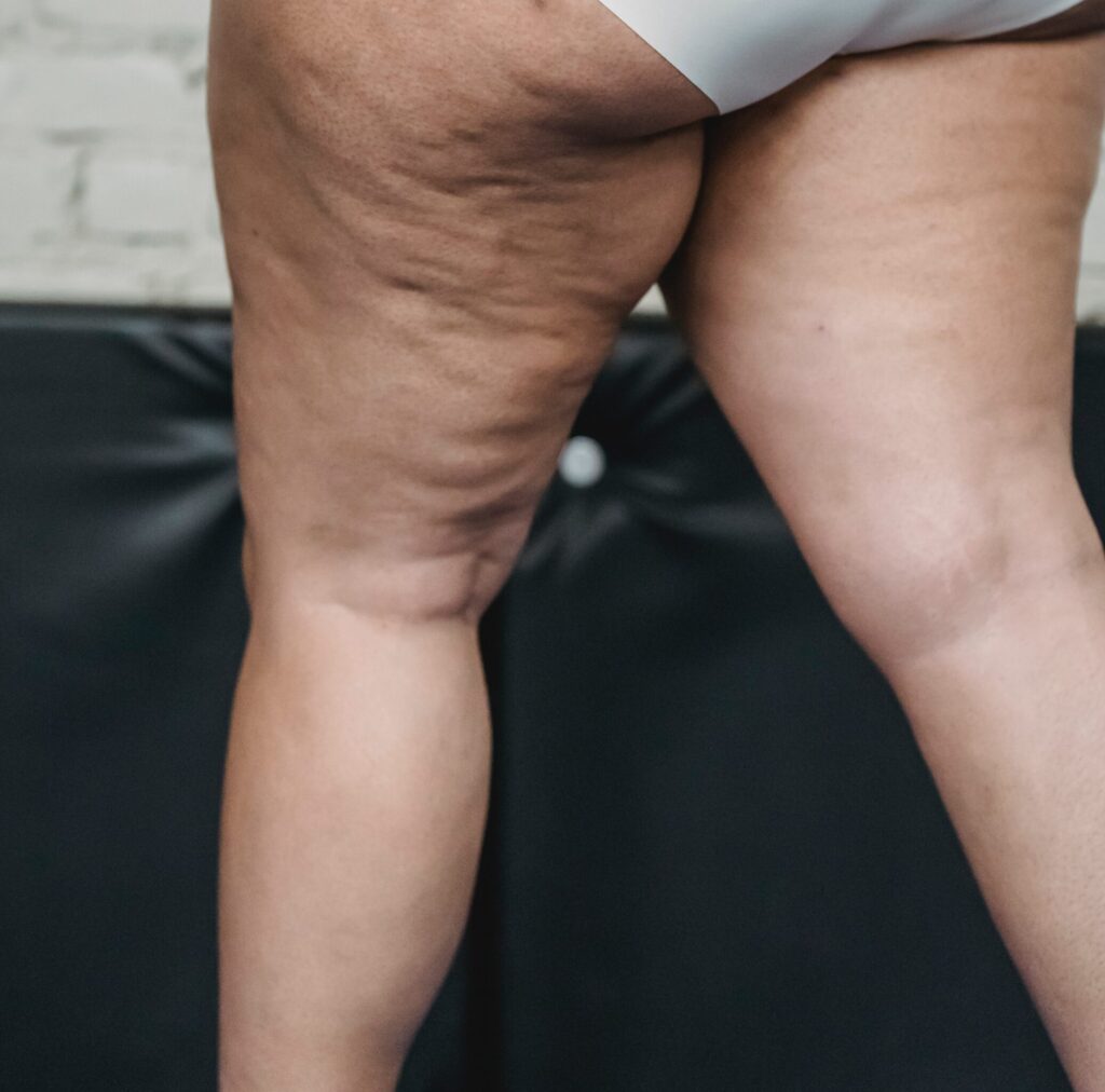 Lymphedema Obesity Exploring the Causes and Treatments